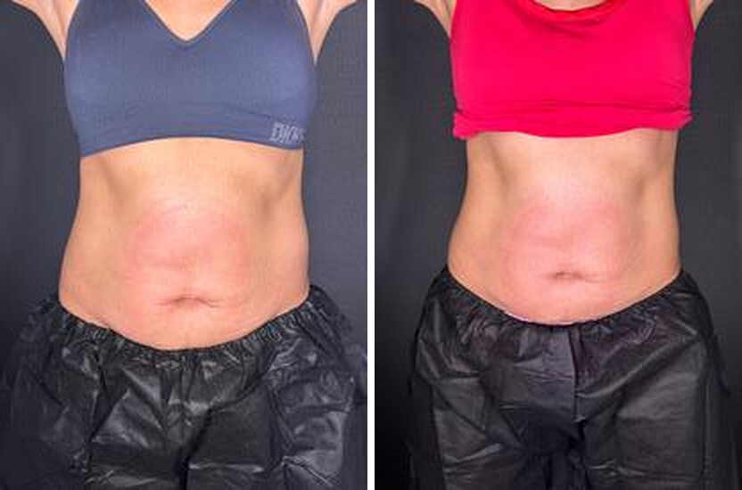 Front view. Before and after body contouring results, real Skin Lab patient; individual results vary