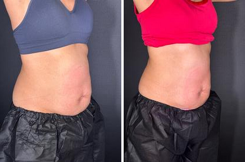 Angled view. Before and after body contouring results, real Skin Lab patient; individual results vary