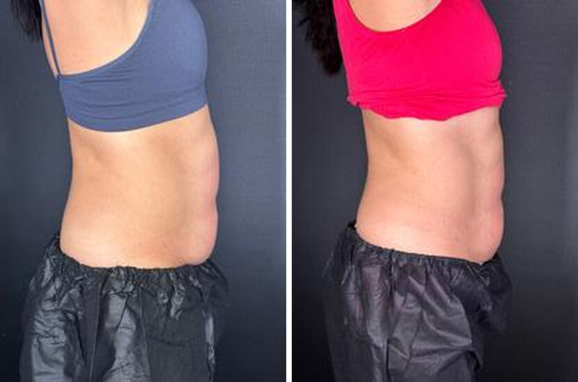 Side view. Before and after body contouring results, real Skin Lab patient; individual results vary