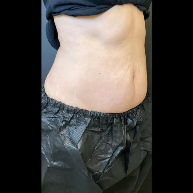 After Image: Emsculpt Neo - right-front-oblique