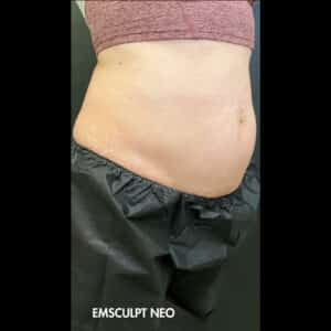 Before Image: Emsculpt Neo