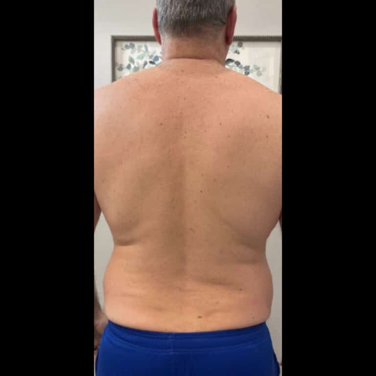 After Image: Male Laser Hair Removal - back