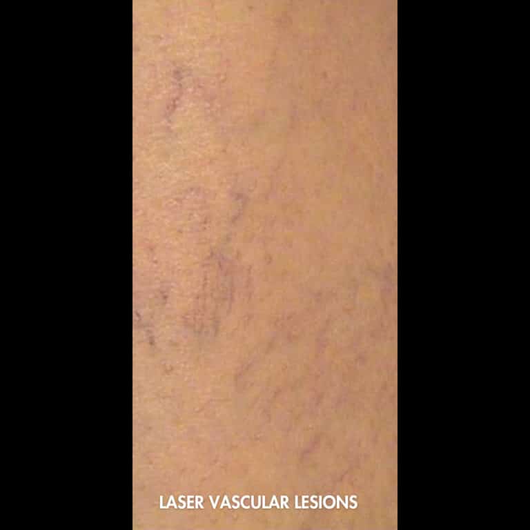 Before Image: Laser Vascular Lesions - front