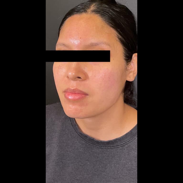 After Image: Microneedling and PRP - left-front-oblique