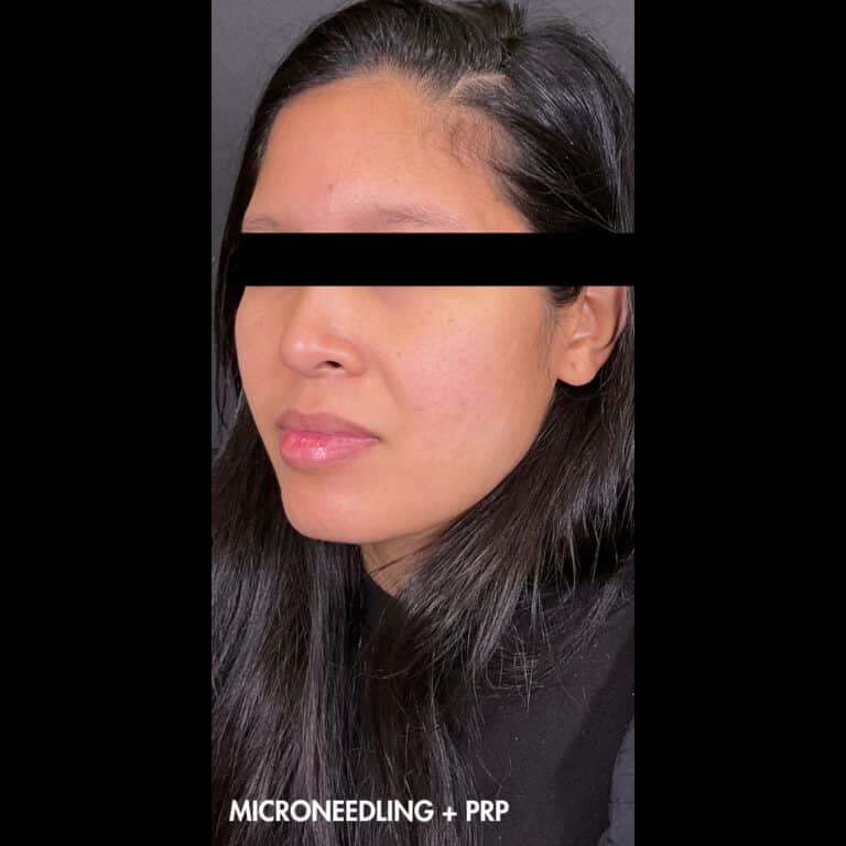 Before Image: Microneedling and PRP - left-front-oblique