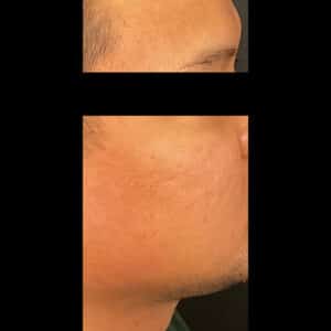 After Image: Microneedling and PRP