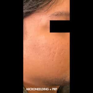 Before Image: Microneedling and PRP